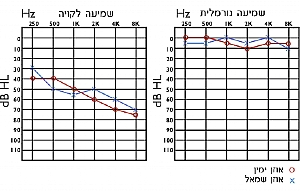אודיוגרמה - בעל שמיעה לקויה ונורמלית