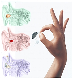 7 עובדות על התאמה אישית של מכשיר שמיעה